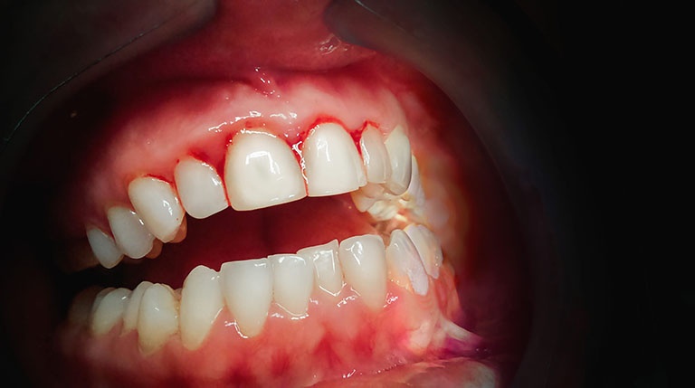 Mức độ nguy hiểm khi răng sâu bị chảy máu