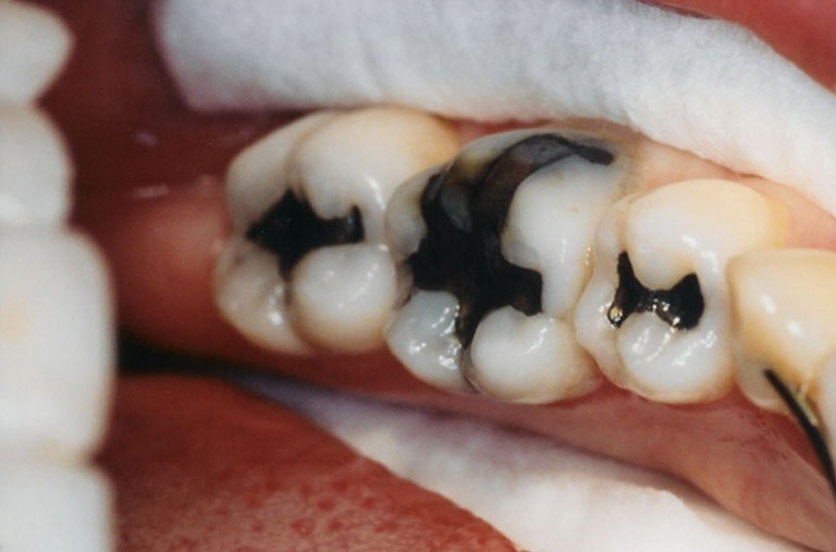 Sâu răng lâu năm là gì?