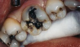 Biện pháp khắc phục sâu răng lâu năm