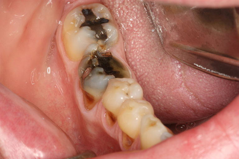 Sâu răng để lâu năm có sao không?
