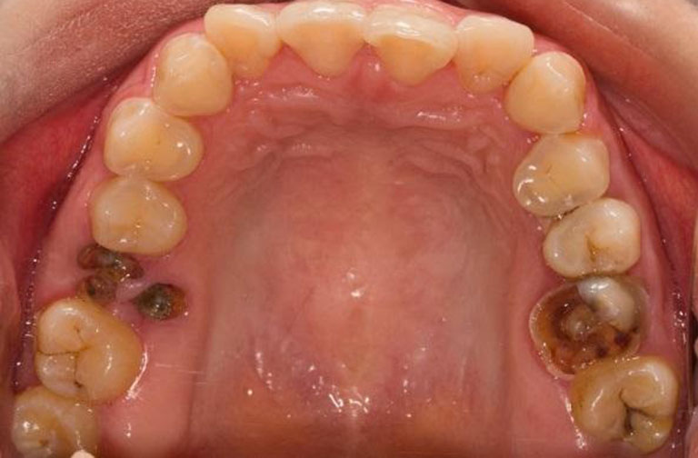 Sâu răng mặt nhai là gì?