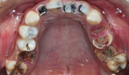 Sâu răng mặt nhai có nguy hại không?