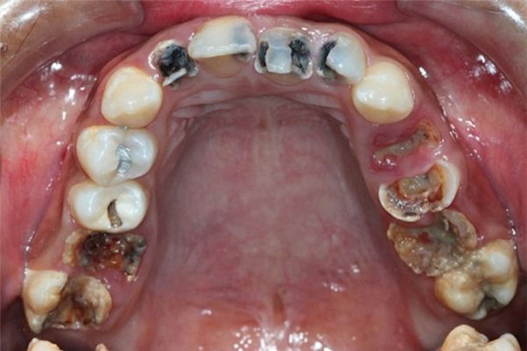 Sâu răng mặt nhai có nguy hại không?