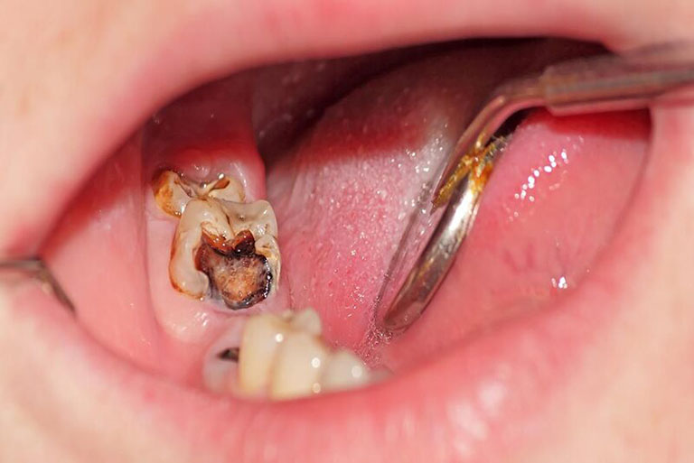 Dấu hiệu nhận biết sâu răng số 6