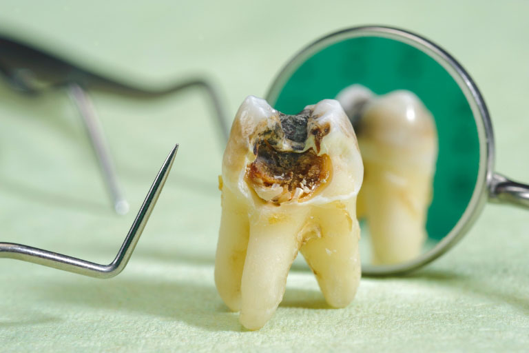 Sâu răng số 6 nguy hiểm như thế nào?