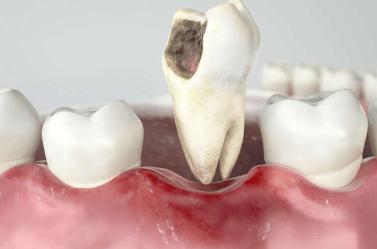 Sâu răng số 6 có nên nhổ không?