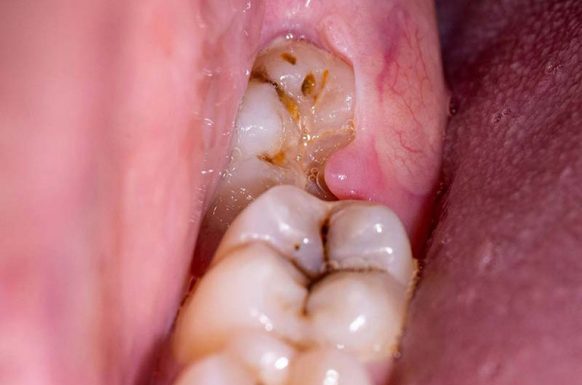 Nguyên nhân gây sâu răng sưng lợi có mủ