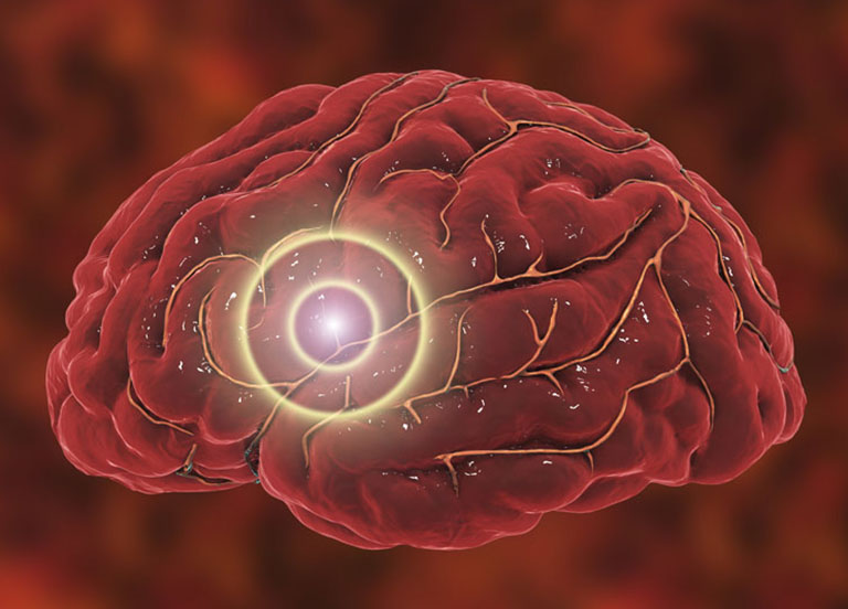 Tắc nghẽn mạch máu não là gì?
