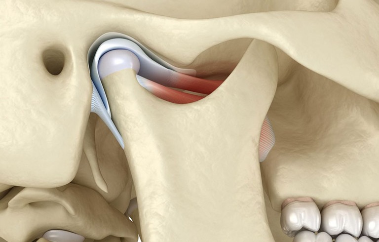 Khái niệm thoái hóa khớp thái dương hàm