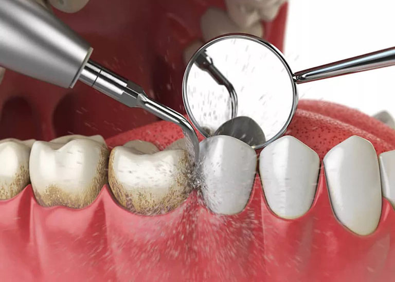 Nguyên nhân và triệu chứng viêm chóp răng
