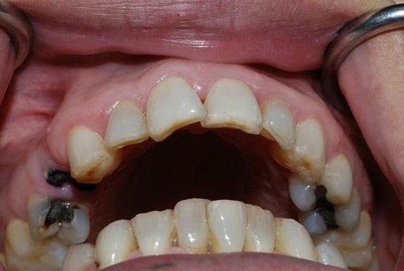 Đau răng sâu là do đâu?