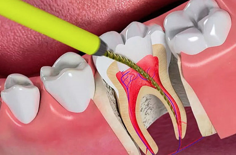 Diệt tủy răng có hại hay ảnh hưởng gì không?