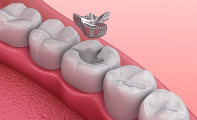 Vật liệu dùng để hàm trám răng sâu là gì?