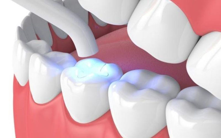 Vật liệu dùng để hàm trám răng sâu là gì?