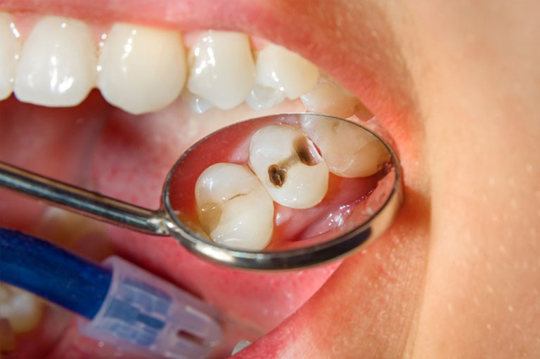 Các bước hàn răng sâu tại nha khoa