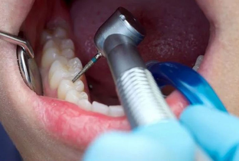Các bước hàn răng sâu tại nha khoa