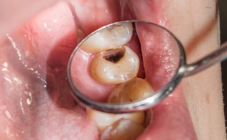 Răng chết tủy là như thế nào?