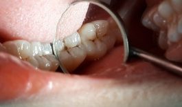 Vì sao răng lại bị chết tủy?