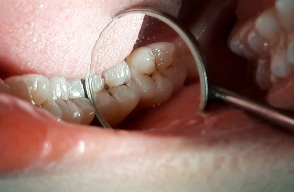Vì sao răng lại bị chết tủy?