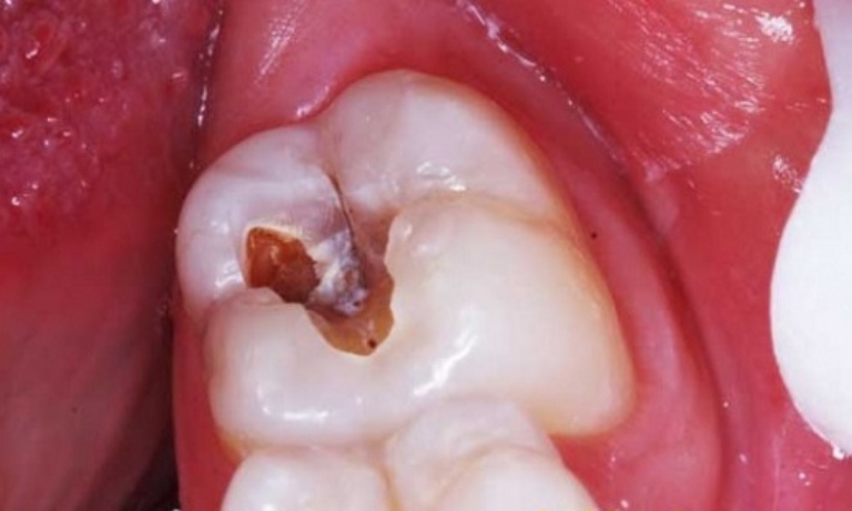 Răng chết tủy tồn tại được bao lâu?