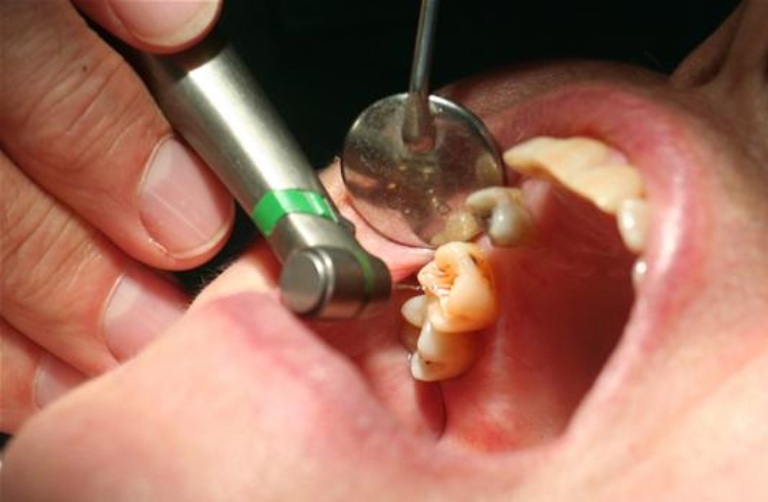 Răng điều trị tủy là như thế nào?