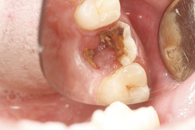Răng sâu bị vỡ là gì? 