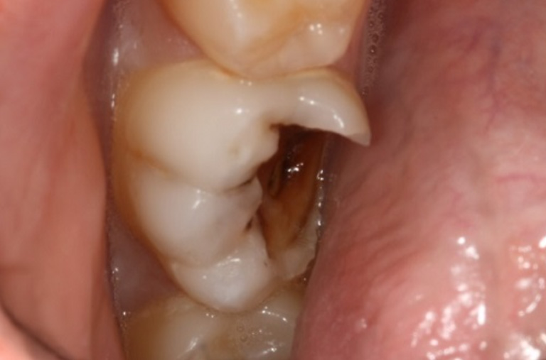 Nhận biết tình trạng răng sâu bị vỡ