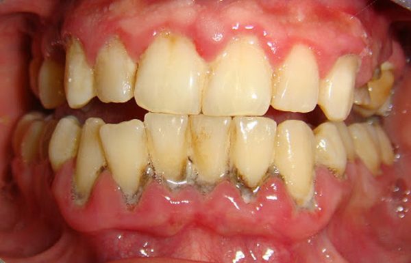 Sâu chân răng là gì?