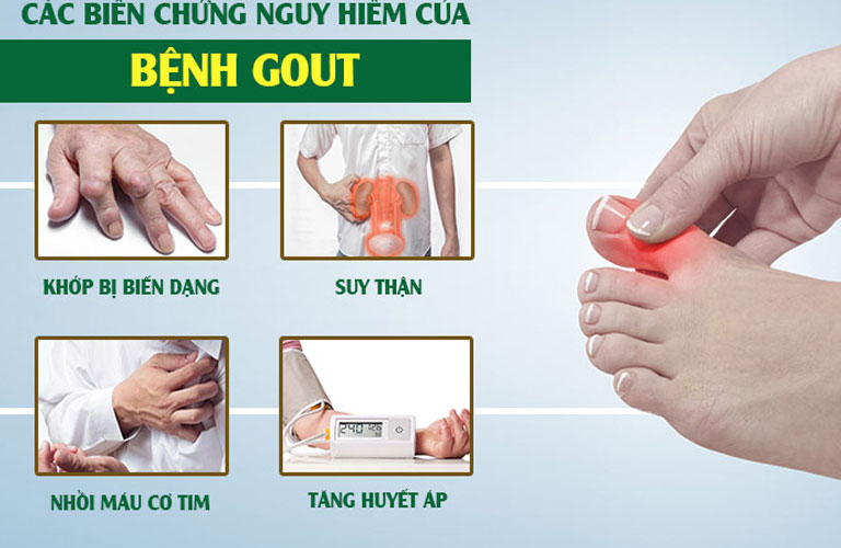 Bệnh gout có thể kéo theo những hệ lụy khôn lường
