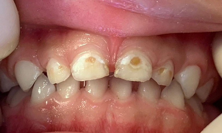 Phân biệt viêm tủy răng có hồi phục và không hồi phục