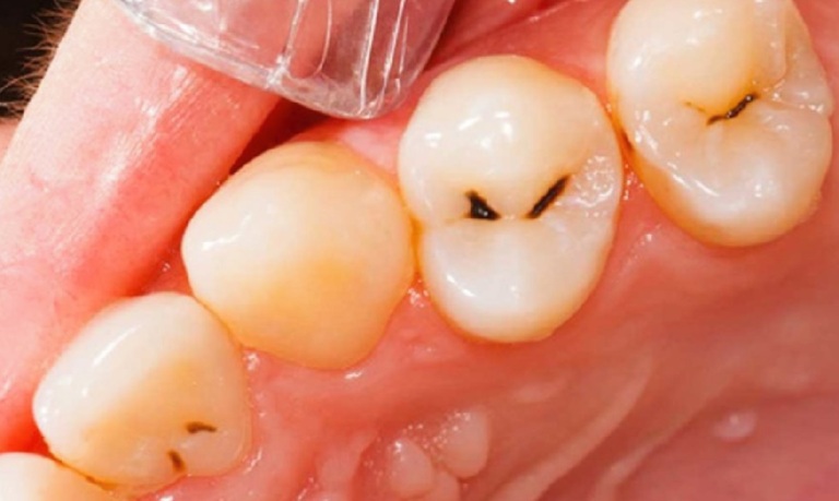 Phân biệt viêm tủy răng có hồi phục và không hồi phục