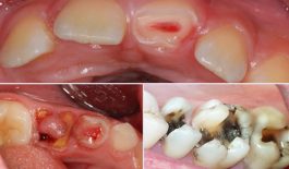 Cách điều trị viêm tủy răng có hồi phục và không hồi phục
