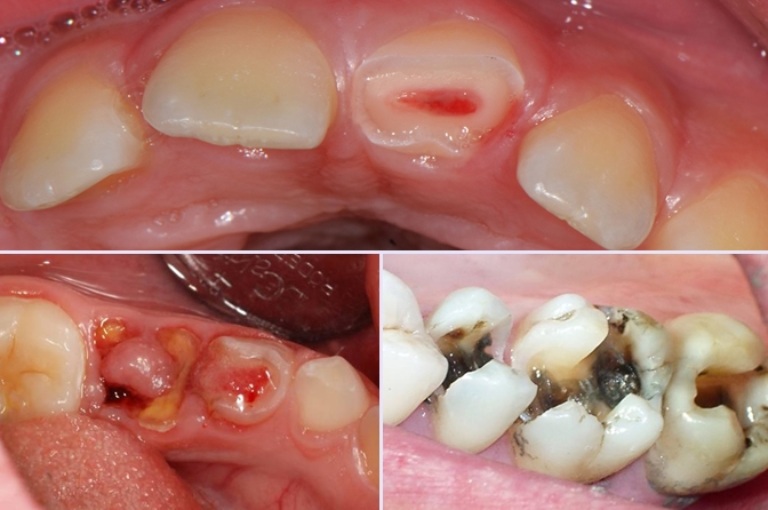 Cách điều trị viêm tủy răng có hồi phục và không hồi phục