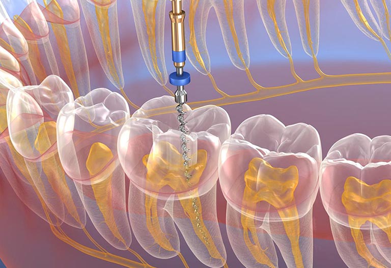 Phương pháp điều trị viêm tủy răng số 6,7