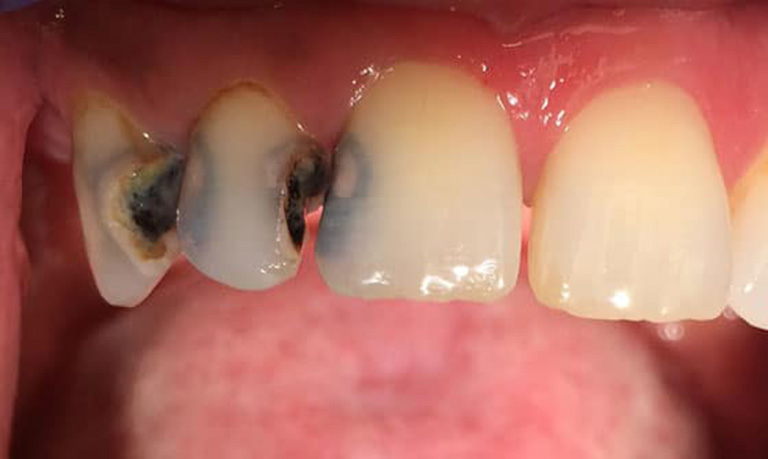Phương pháp diệt tủy răng là gì?