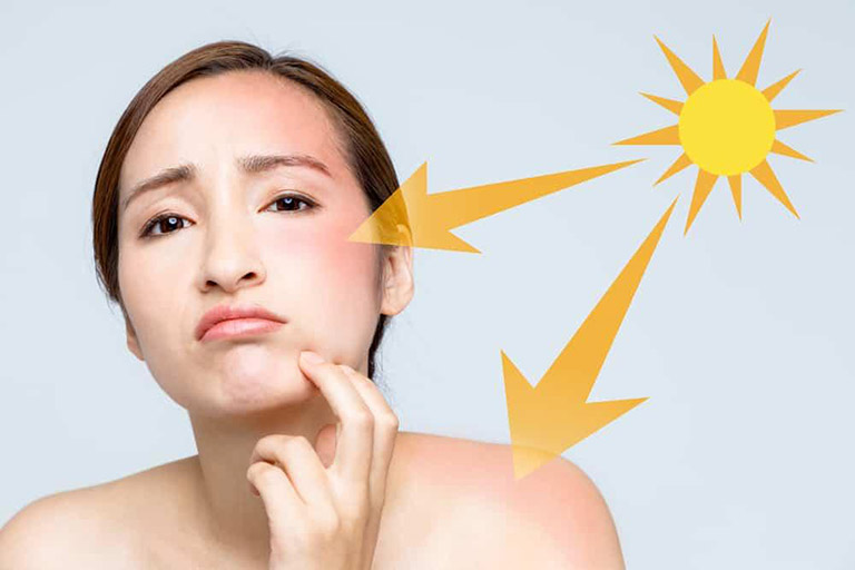 Chống nắng bảo vệ da là điều cần thiết khi trị nám da