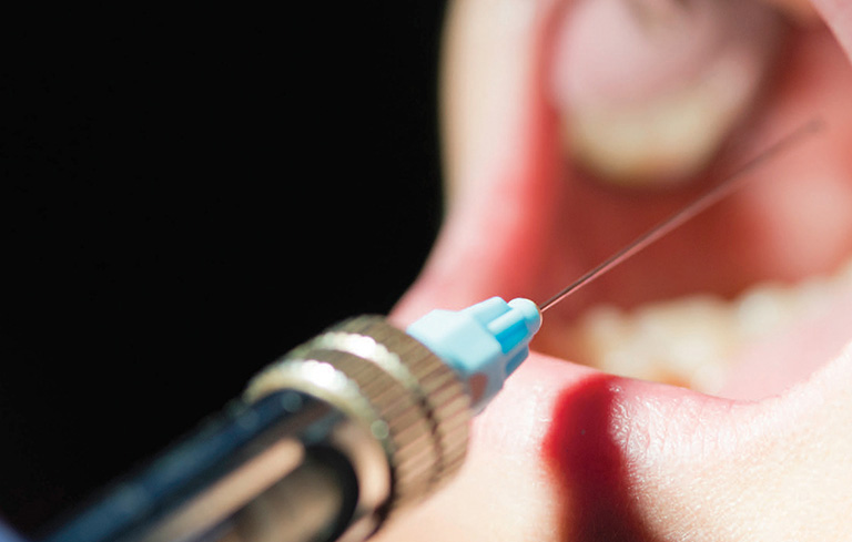 Một số vấn đề khi chích thuốc tê lấy tủy răng