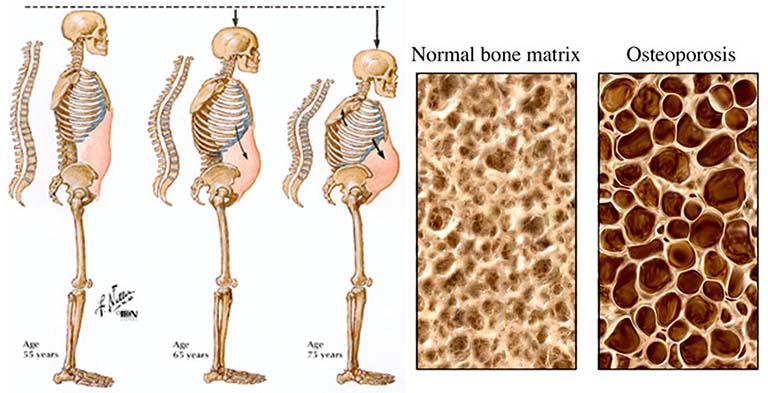 Nguyên nhân của bệnh loãng xương