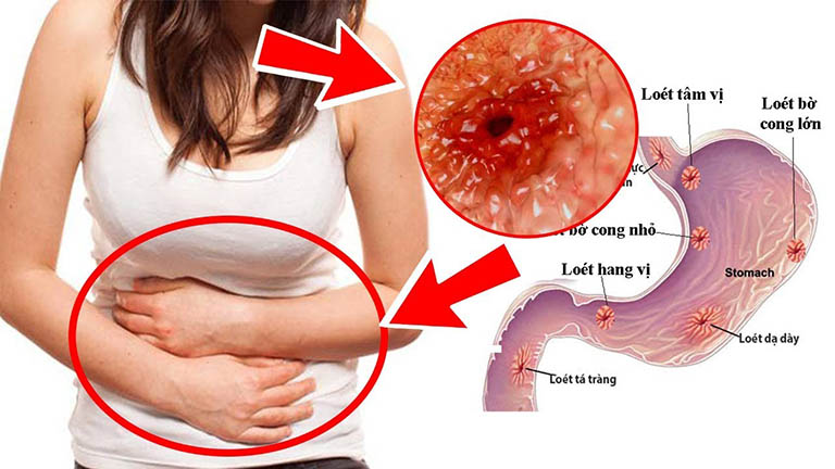 bệnh viêm loét dạ dày tá tràng là gì