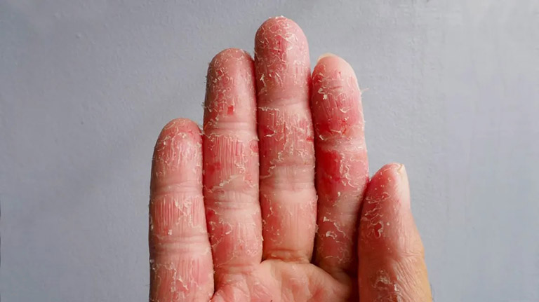 bệnh chàm eczema