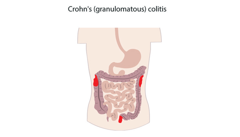 bệnh crohn nguyên nhân