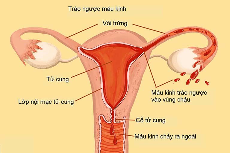 bệnh lạc nội mạc tử cung là gì