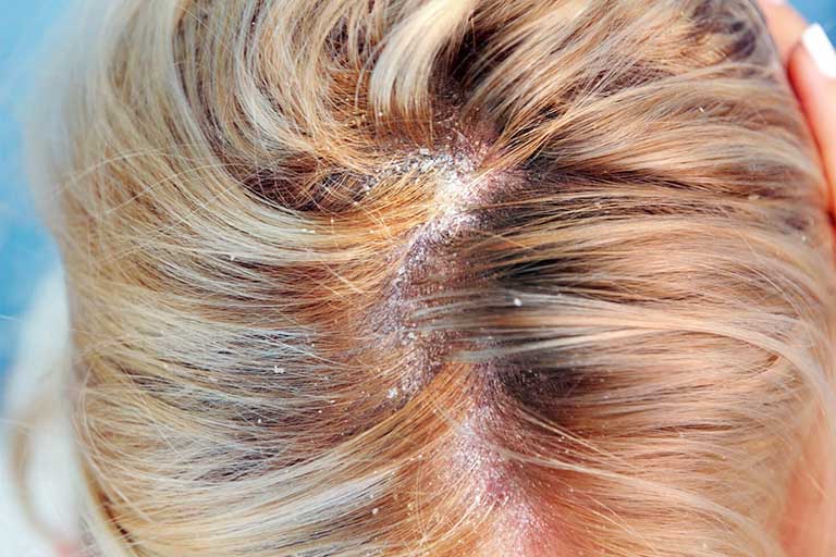 bệnh nấm da đầu là gì