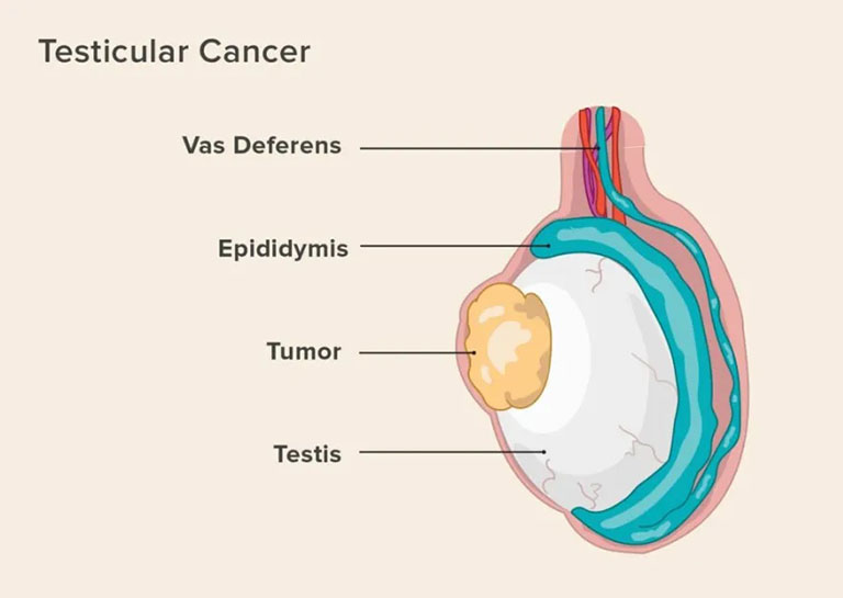 ung thư tinh hoàn là gì