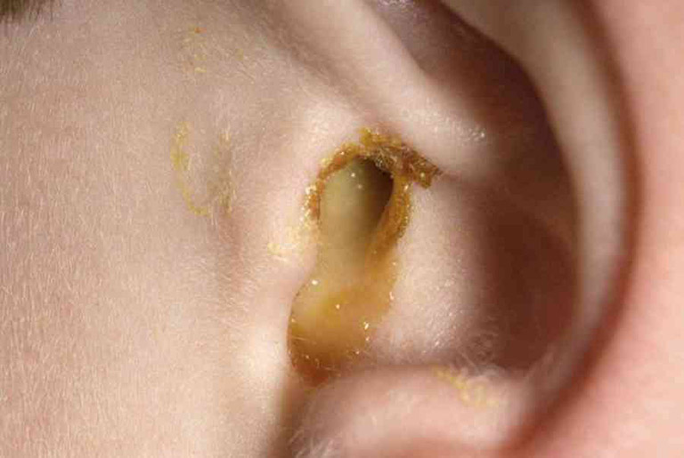 Bệnh viêm tai giữa