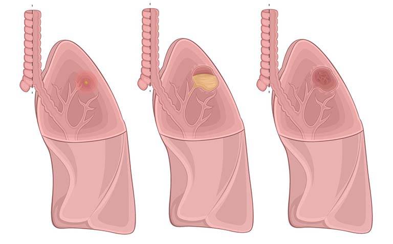bệnh áp xe phổi