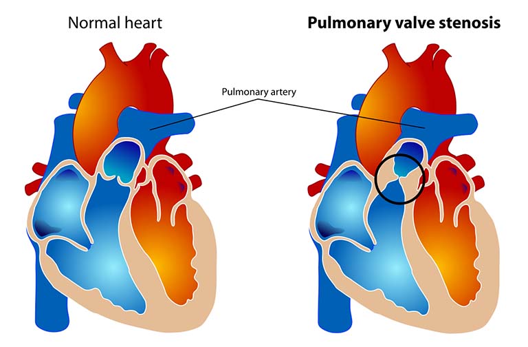 Bệnh Hẹp Động Mạch Phổi