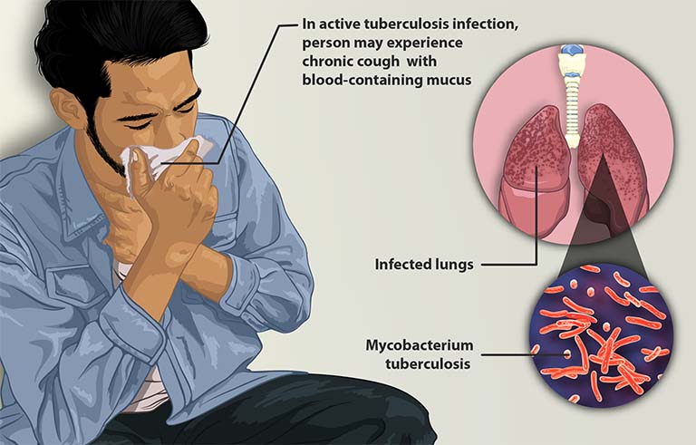 nguyên nhân gây ra bệnh lao phổi là gì