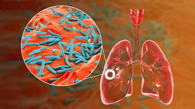 bệnh lao phổi là gì