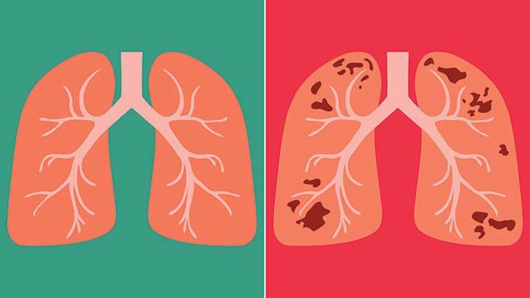 Bệnh lao phổi là gì